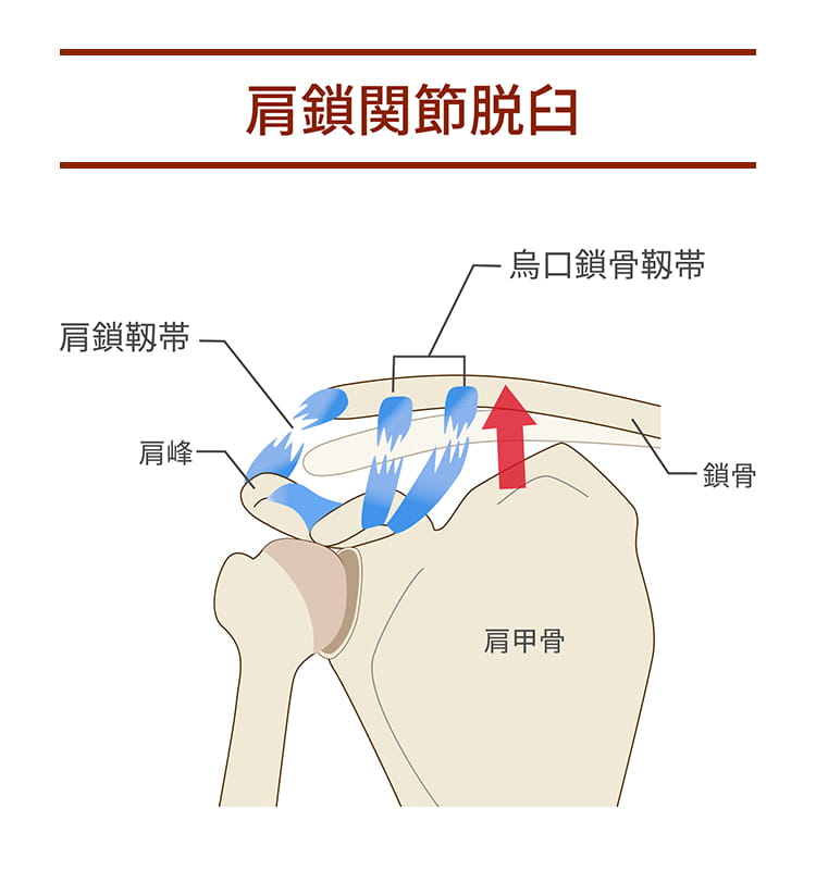 肩鎖関節脱臼
